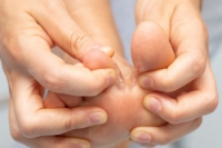 Definition and Causes of Athlete’s Foot
