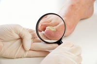Understanding How Fungal Nail Infections Occur